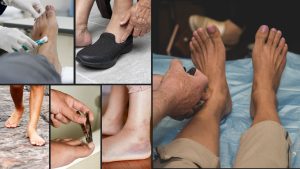 मेरे पास मधुमेह है: मेरे पैरों का ध्यान क्यों और कैसे रखना चाहिए? Hindi digital medical resources by the Humanitarian medical organisation Developing Medicine - Diabetic foot disease