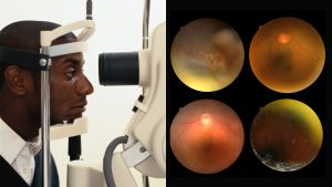 मधुमेह प्रबंधन - Hindi diabetic management digital medical resources by the Humanitarian Medical Organisation Developing Medicine - Diabetic retinopathy