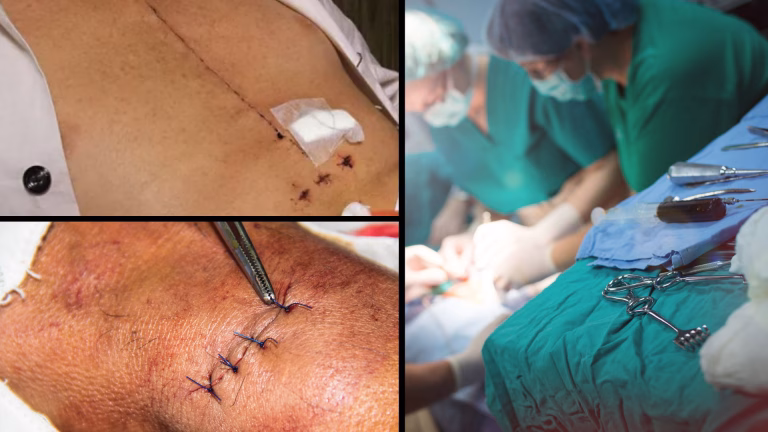 ශල්යකර්ම - Sinhala digital medical resources by the Humanitarian Medical Organisation Developing Medicine - Surgery