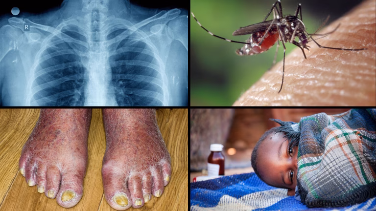 Digital medical resources by the Humanitarian Medical Organisation Developing Medicine - Common infections