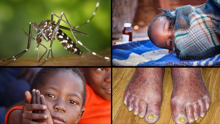 Digital medical resources by the Humanitarian Medical Organisation Developing Medicine - Common infections Ressources médicales numériques de l'Organisation médicale humanitaire Developing Medicine - Infections courantes