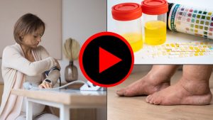 ¿Qué es la preeclampsia? Nuestros médicos explican los signos y síntomas comunes de esta afección. What is pre-eclampsia? Our doctors explain the common signs and symptoms of this condition.