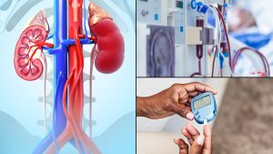 දියවැඩියා වකුගඩු රෝගය යනු කුමක්ද? දියවැඩියා වකුගඩු රෝගයට හේතුව කුමක්ද සහ එය වර්ධනය වීමේ අවදානම අඩු කර ගන්නේ කෙසේද යන්න අපගේ වෛද්‍යවරු පැහැදිලි කරති. What is diabetic kidney disease? Our doctors explain what causes diabetic kidney disease and how to reduce your risk of developing it.